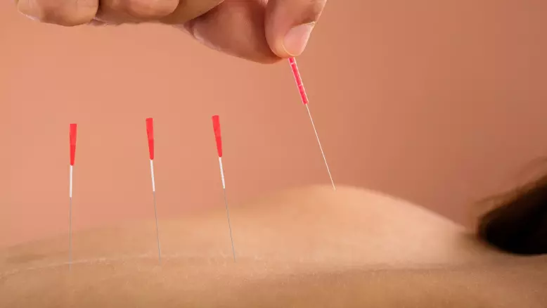 Acupuncture for weight loss - the forgotten weight loss solution?